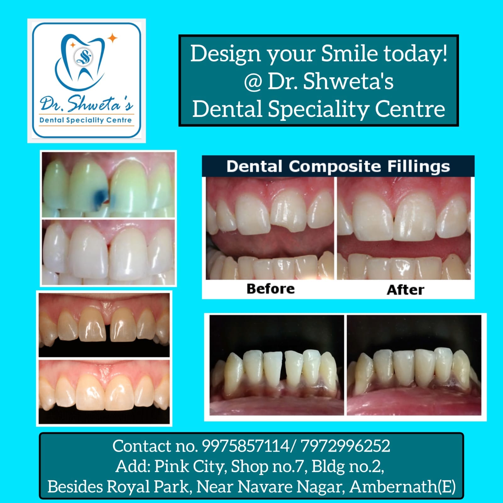 Before and after clinical photographs of tooth-coloured composite fillings and smile design