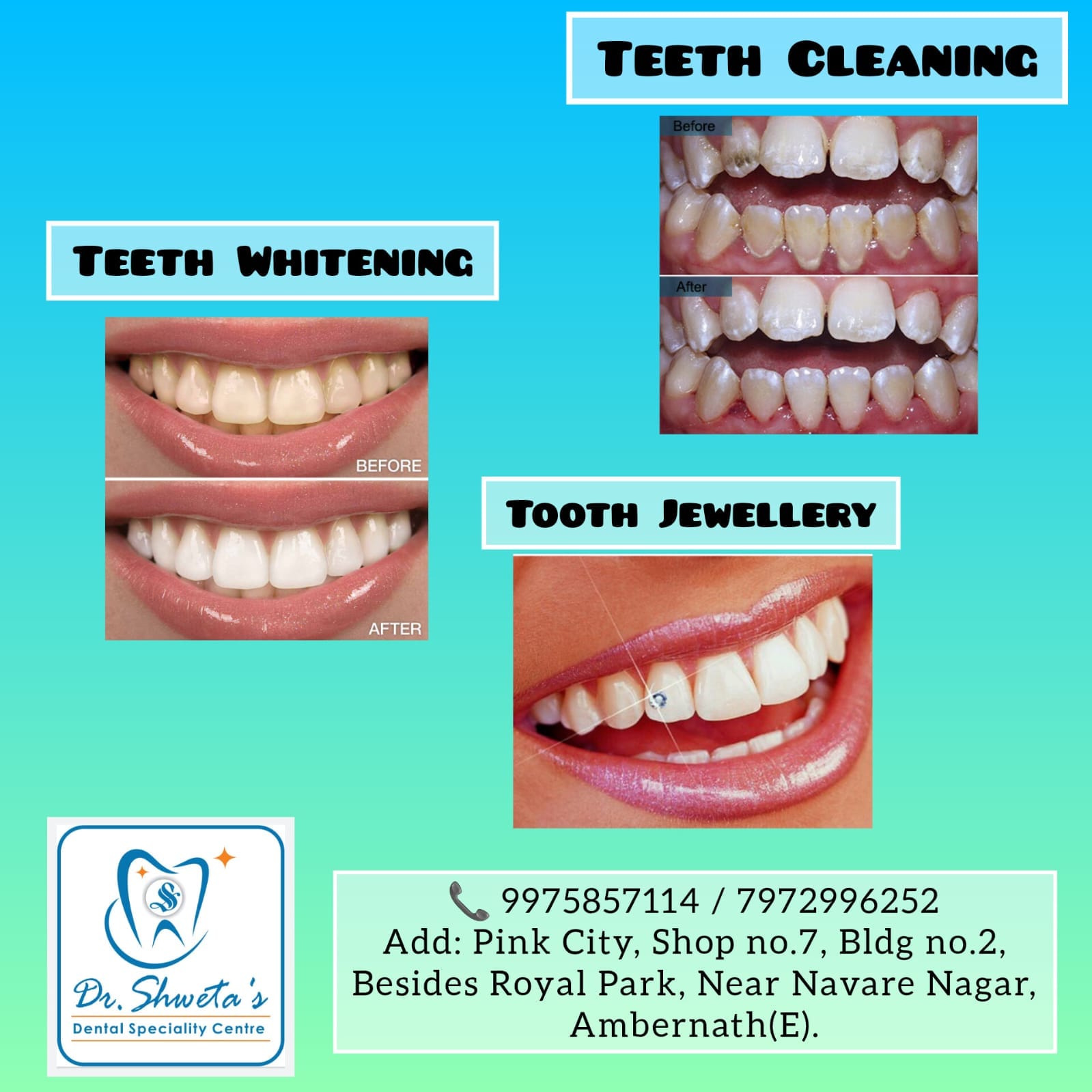 Before and after clinical photographs of teeth cleaning, whitening and tooth jewellery